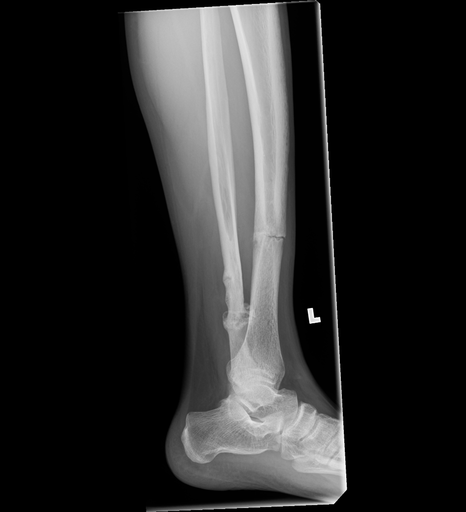 Tibial Stress Fractures The Bone School